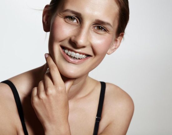 Aparat dentar conventional vs gutiere transparente Ce ti se potriveste