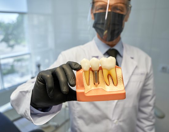 Etapele implantului dentar Procedura pas cu pas